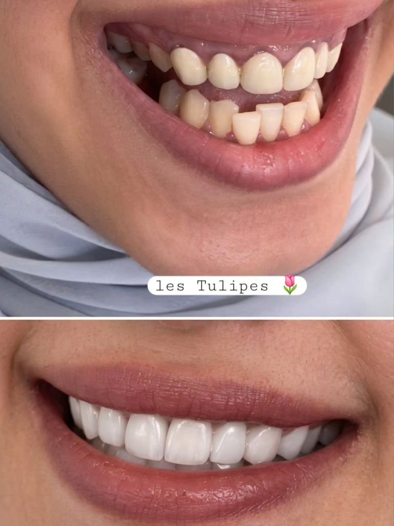 Avant / après – Cas de couronnes Emax avec correction du sourire gingival.
