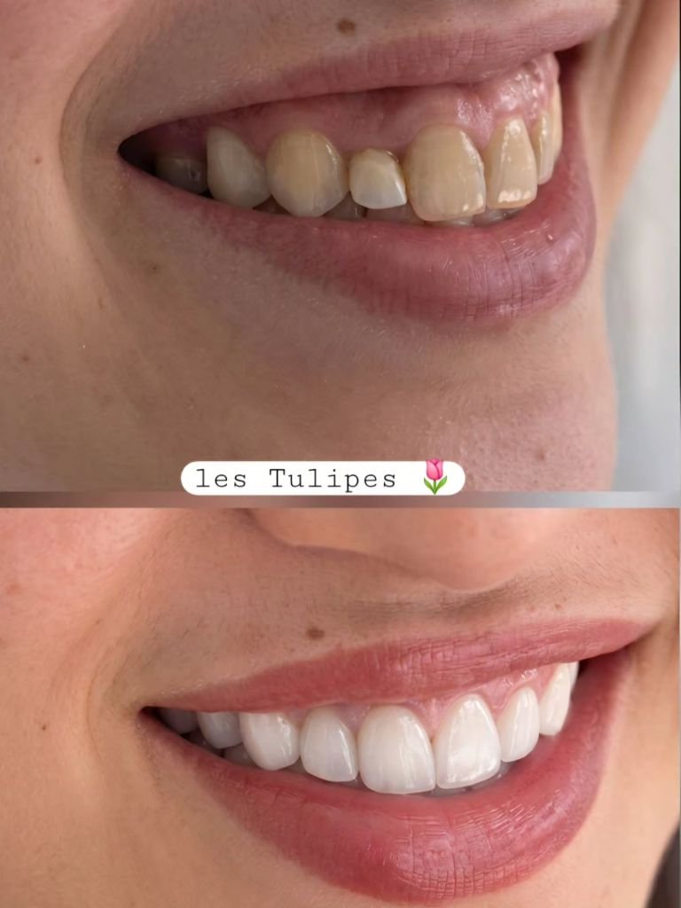Avant / après – Cas de pose de couronnes teinte bleach pour correction d’un sourire gingival
