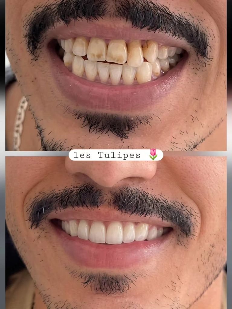 Avant / après – Correction d’un sourire avec pose de couronnes teinte naturelle