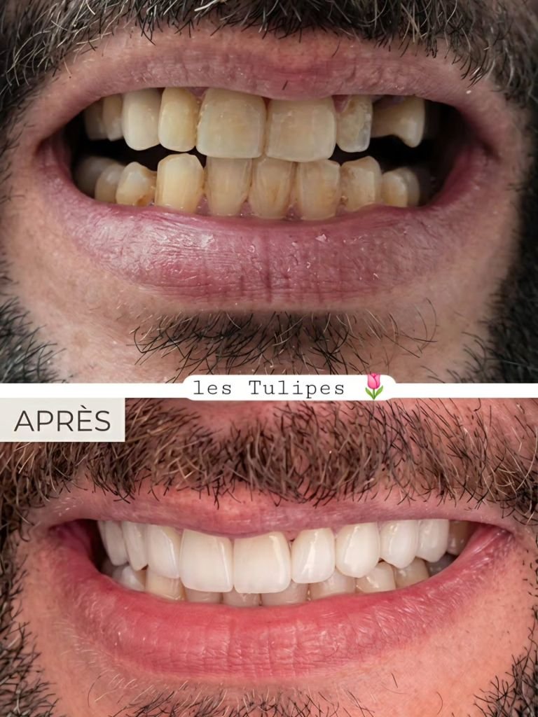 Avant / après – Cas de pose de couronnes teinte B1