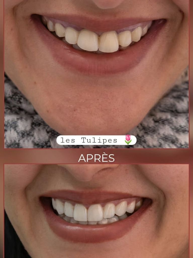 Avant / après – Cas de changement d’anciennes couronnes ceramo_metalliques par des couronnes Emax teinte B1