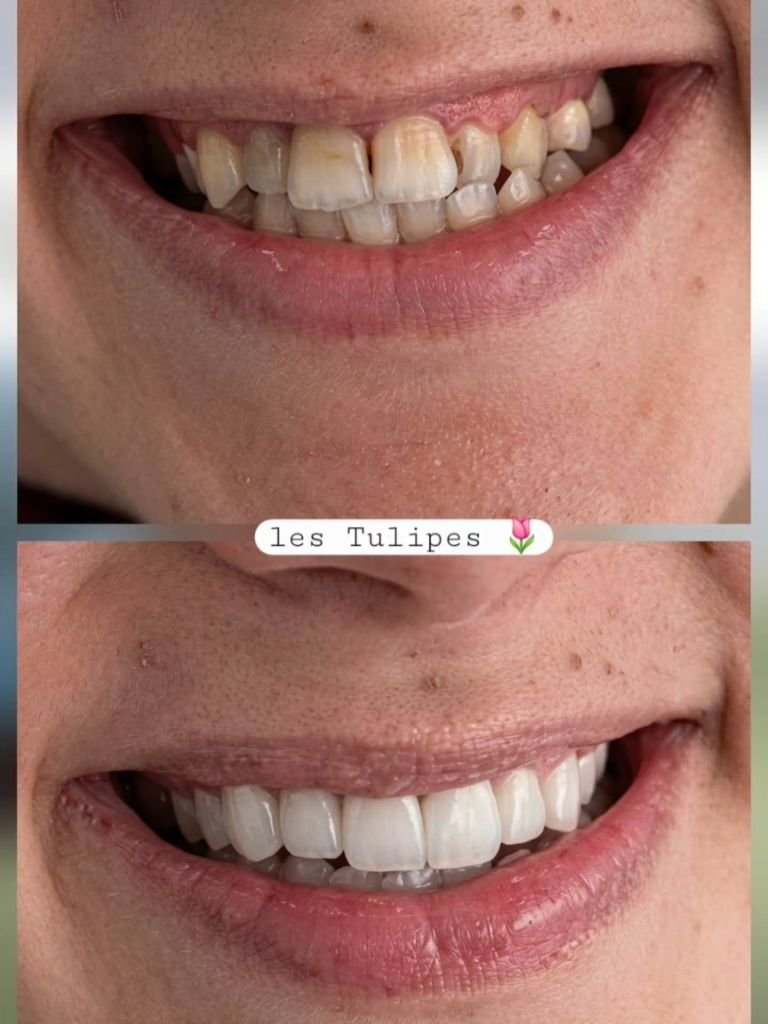 Avant / après – Pose de couronnes Emax pour correction d’un sourire