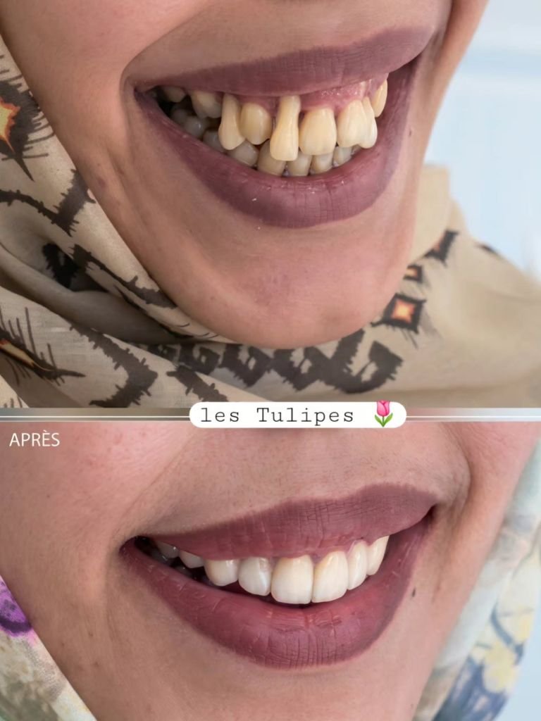 Avant / après – Cas de parodontite agressive stade terminale, traitement par pose de bridge / couronnes Emax teinte 