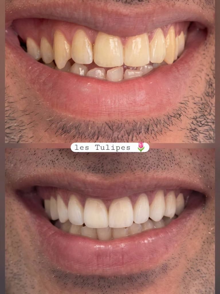 Avant / après – Pose de facettes teinte A1 pour correction d’un sourire avec canine pointue