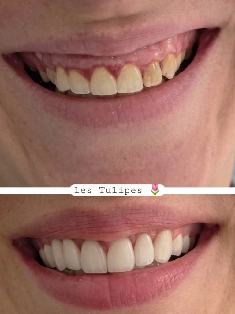 Avant / après – Cas de changements d’anciennes couronnes ceramo metalliques par des couronnes Emax apres chirurgie g