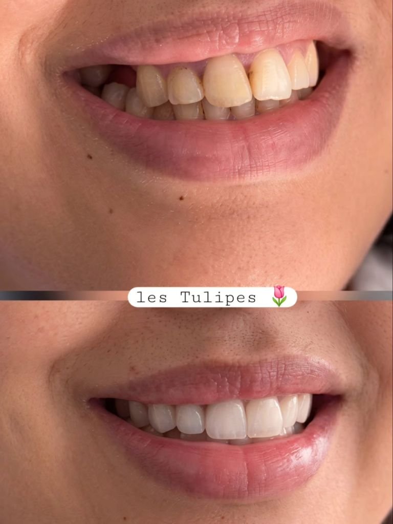 Avant / après – Pose de 6 facettes anterieur teinte B1 . Avec implants posterieurs