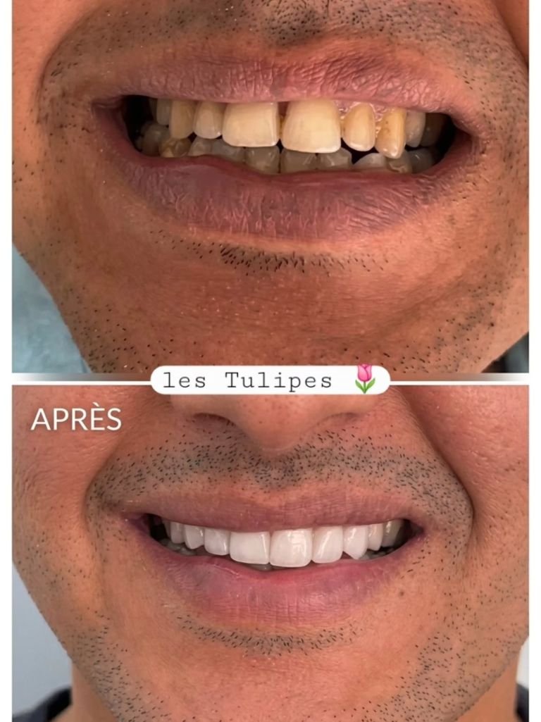 Avant / après – Changement de sourire avec pose de facettes et couronnes Emax.