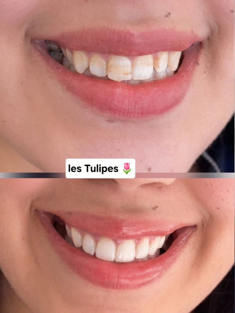 Avant / après – Cas de changement de sourire avec 6 facettes pour traiter une fluorose.