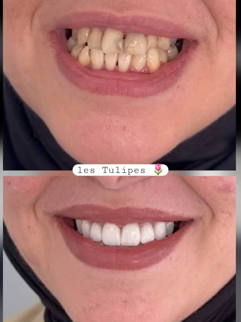 Avant / après – Cas de correction de sourire avec occlusion inversée par facettes et couronnes teinte B1