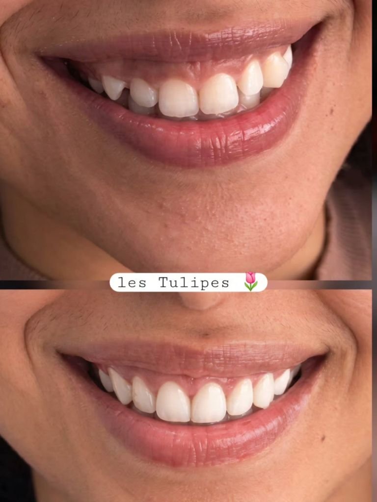 Avant / après – Cas de correction du sourire par gingivectomie + dépigmentation gingivale au laser avec pose de face