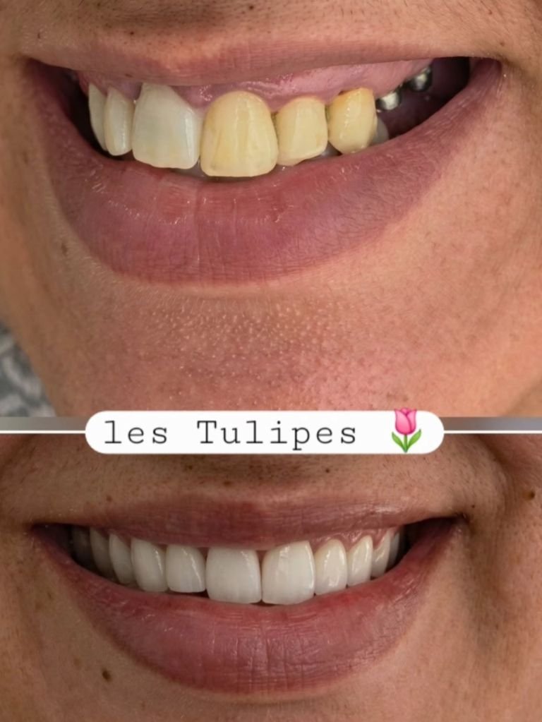 Avant / après – Cas de rehabilitation du sourire par pose de couronnes et implant Emax
