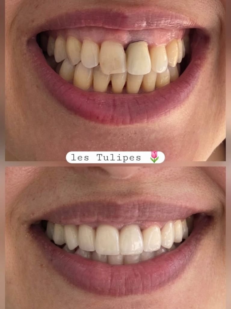 Avant / après – Cas de pose de facettes pour fermeture des trous noirs entre les dents suite à une parodontite agres